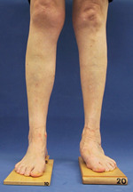  Rheumatoide Fußwurzel links, Rheumatoides Kniegelenk